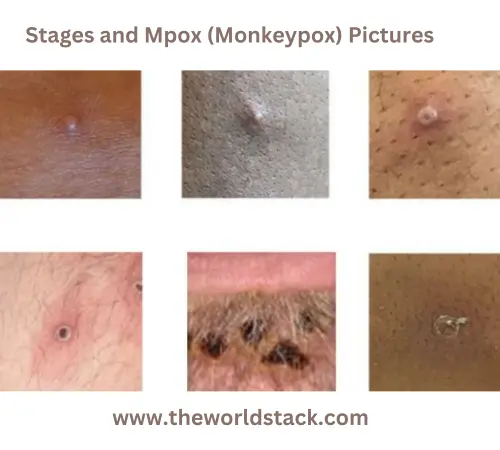 Stages and Mpox (Monkeypox) Pictures