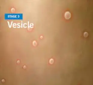 Vesicles Stage 3
